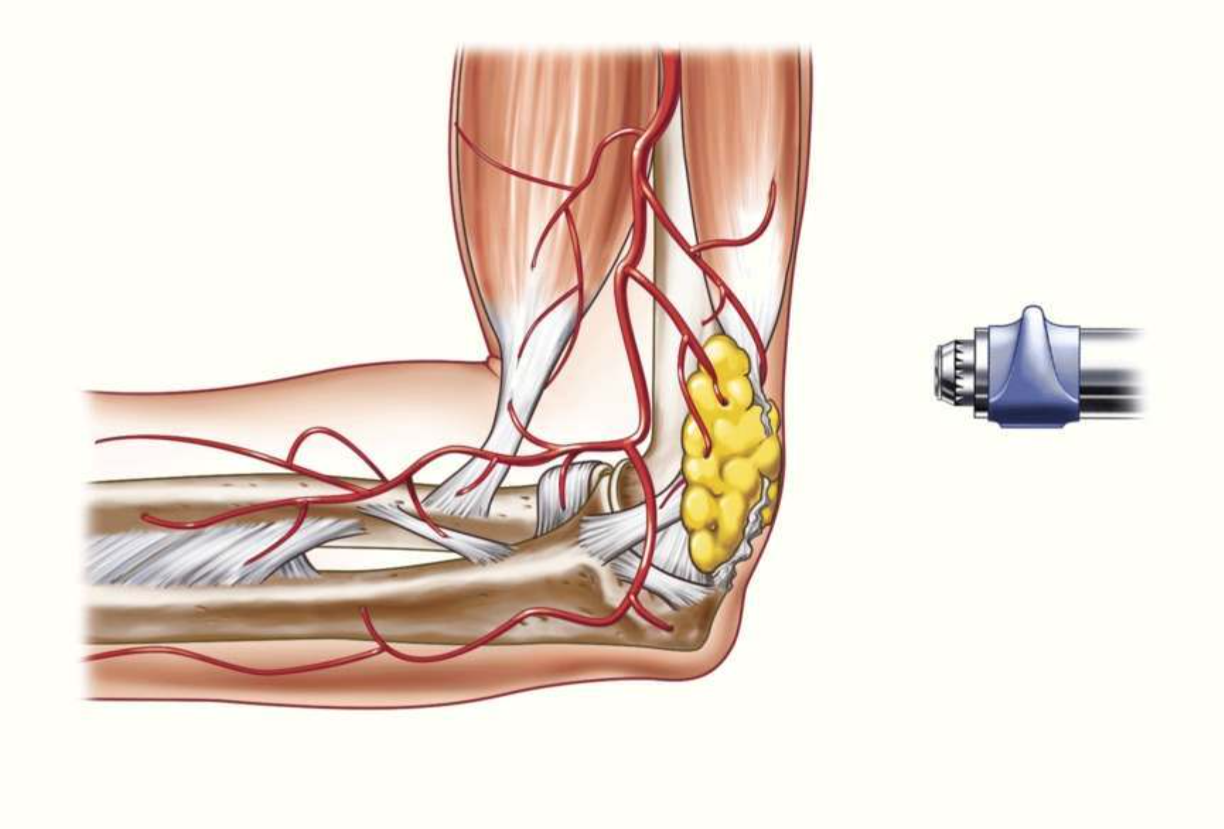 New Cenmade elbow diagram