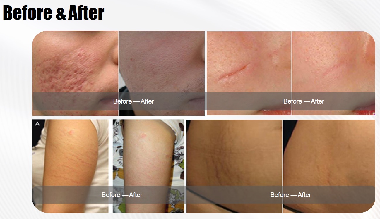 CO2 laser fractional treatment grid results on skin