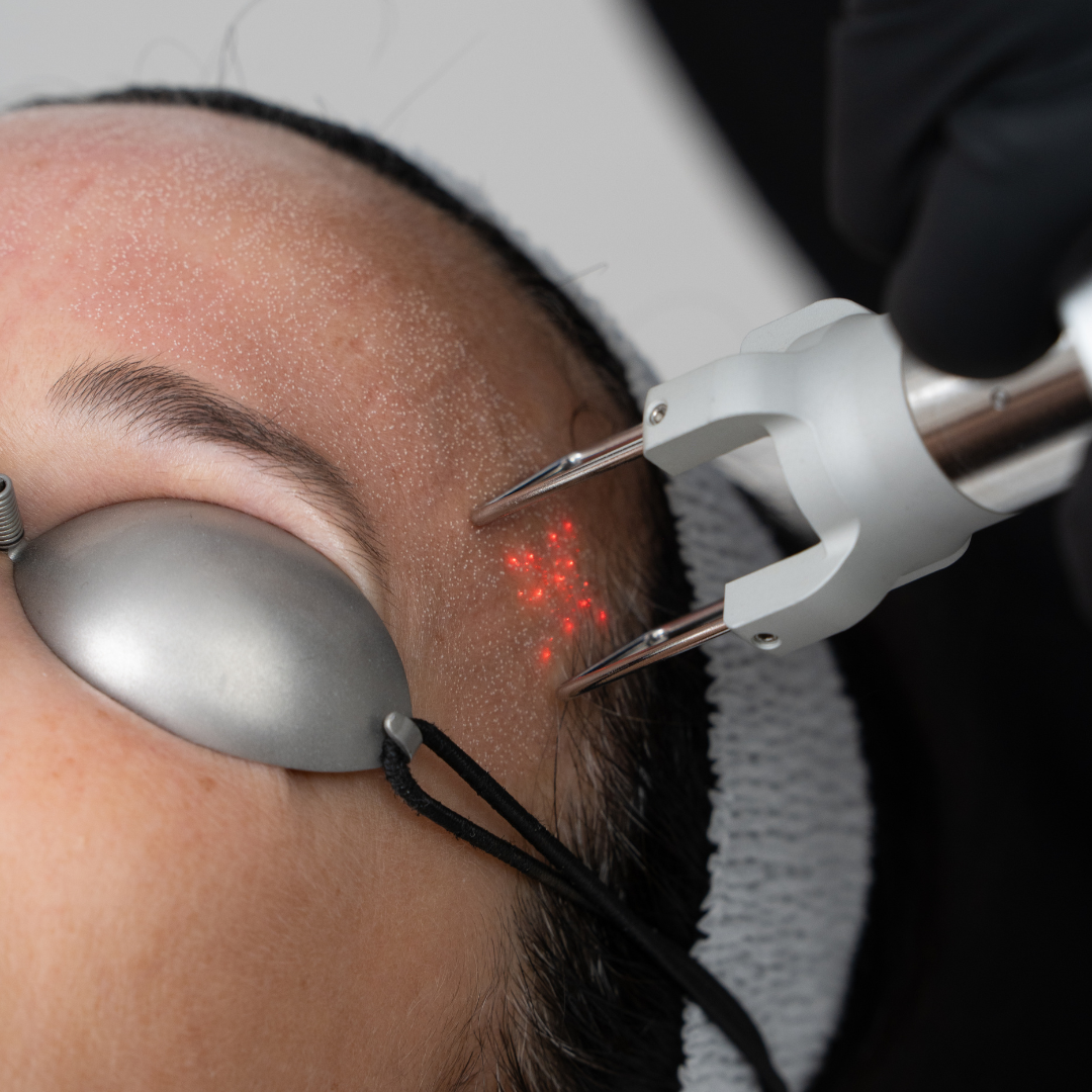 smartlase patient treatment close-up on the forehead
