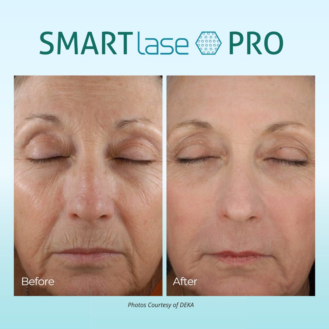 smartlase pro results on aging skin