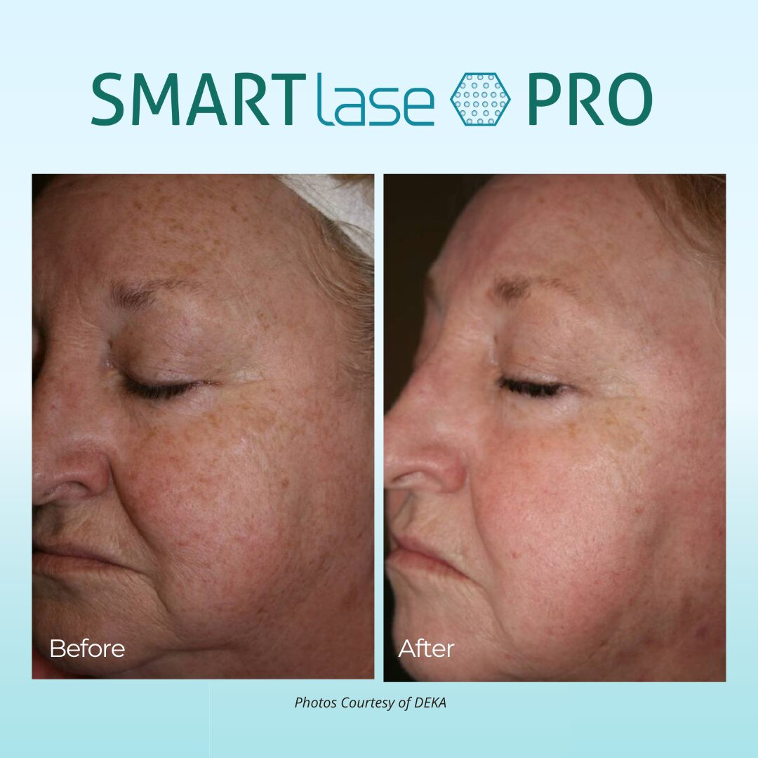 smartlase pro results side profile