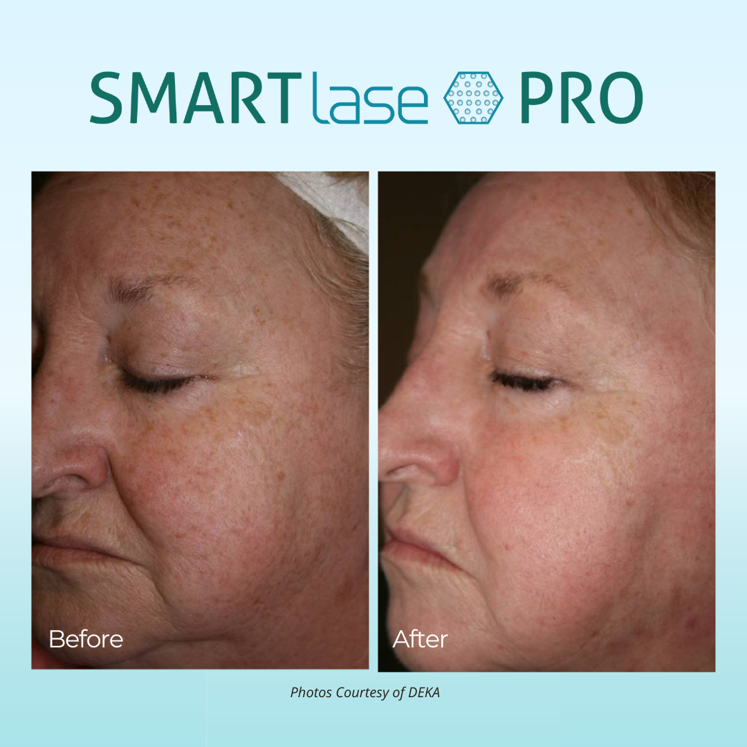 smartlase pro results side profile