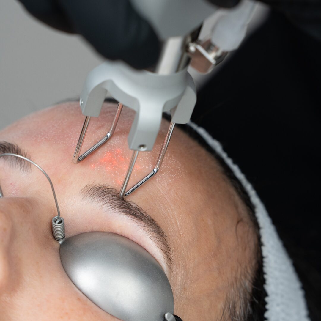 SylfirmX smartlase treatment on patient close-up